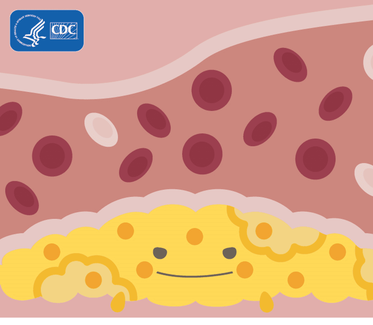 Cartoon of a blood vessel with yellow plaque