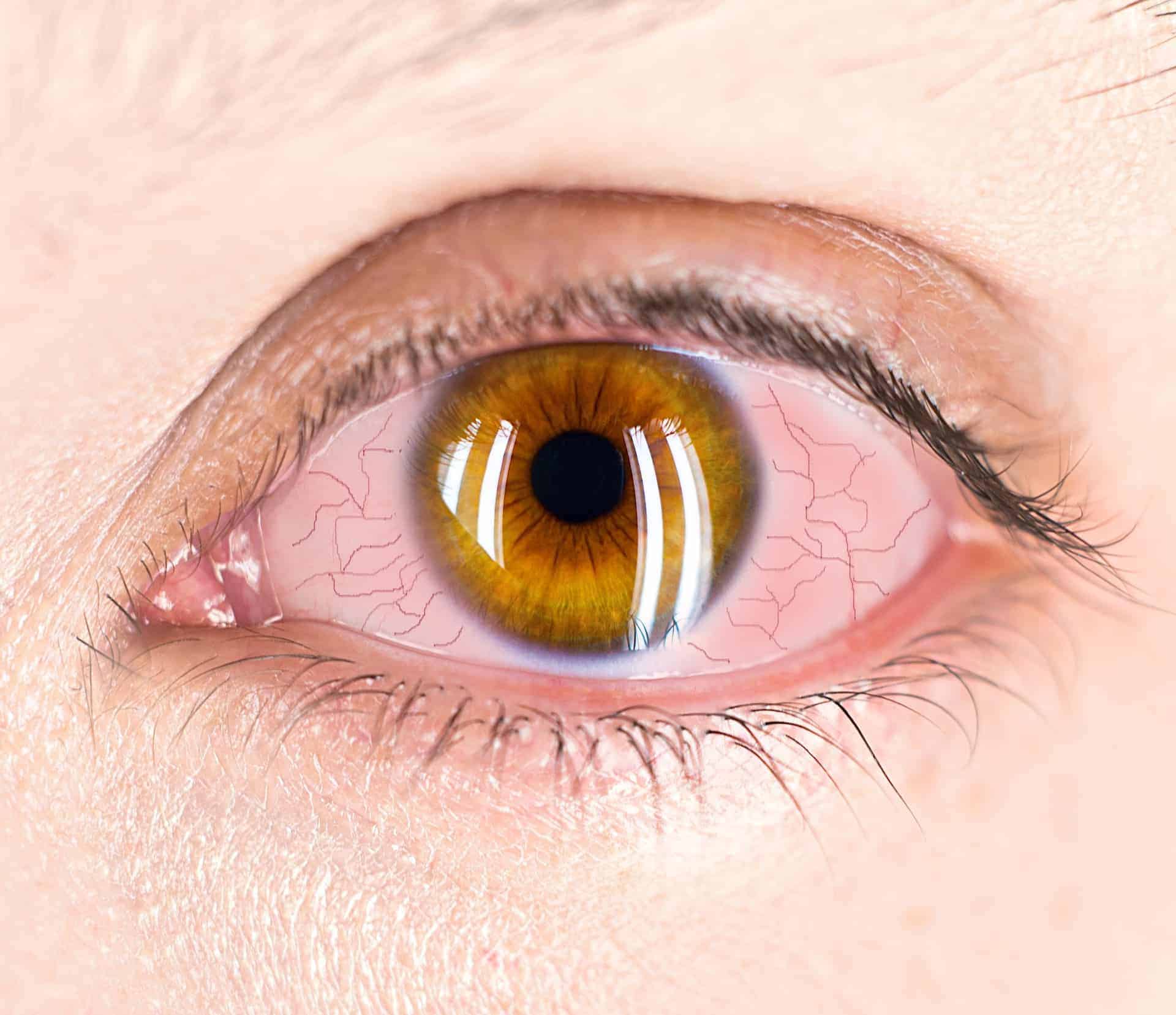 Uveitis: Ocular Inflammation | Weber Vision Care